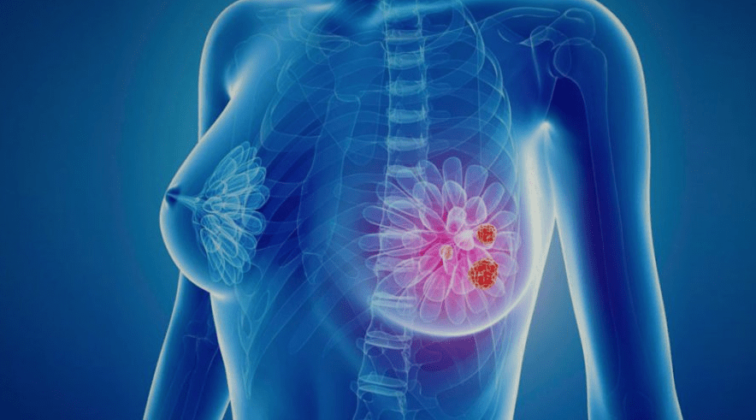 Рак молочної залози