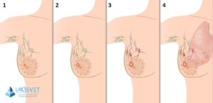 Рак молочної залози